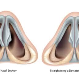 Deviated nasal septum and Straightening a Deviated Nasal Septum