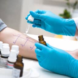 Skin prick allergy test stock photo